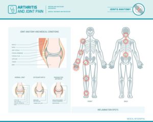 Arthritic joint pain and common areas it occurs