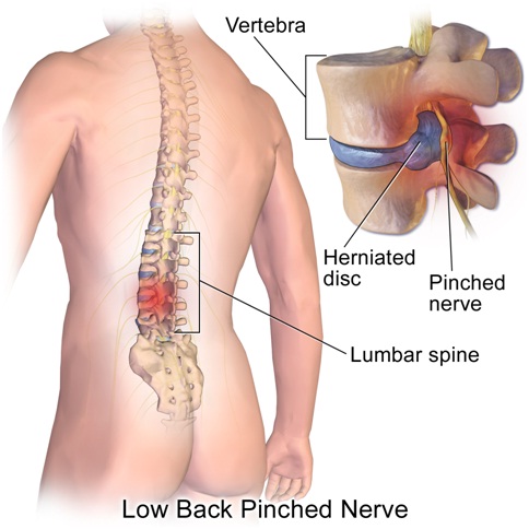 https://stapletonchiropractic.com.au/wp-content/uploads/2018/08/Image-of-Low-Back-Pinched-Nerve.jpg