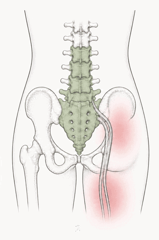 Illustration related to lower back and leg nerve-type pathways